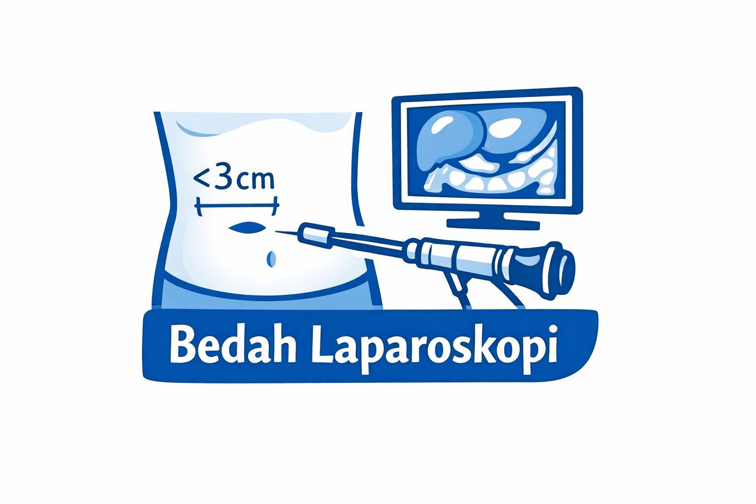 Operasi Cukup dengan Sayatan <3 cm? Ini Penjelasan tentang Laparoskopi